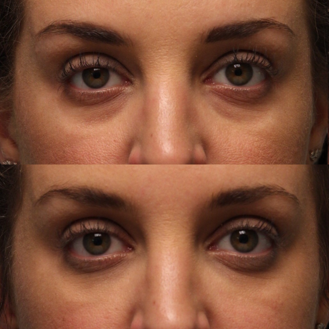 Natural Trough™ Technique (NTT) Filler Training