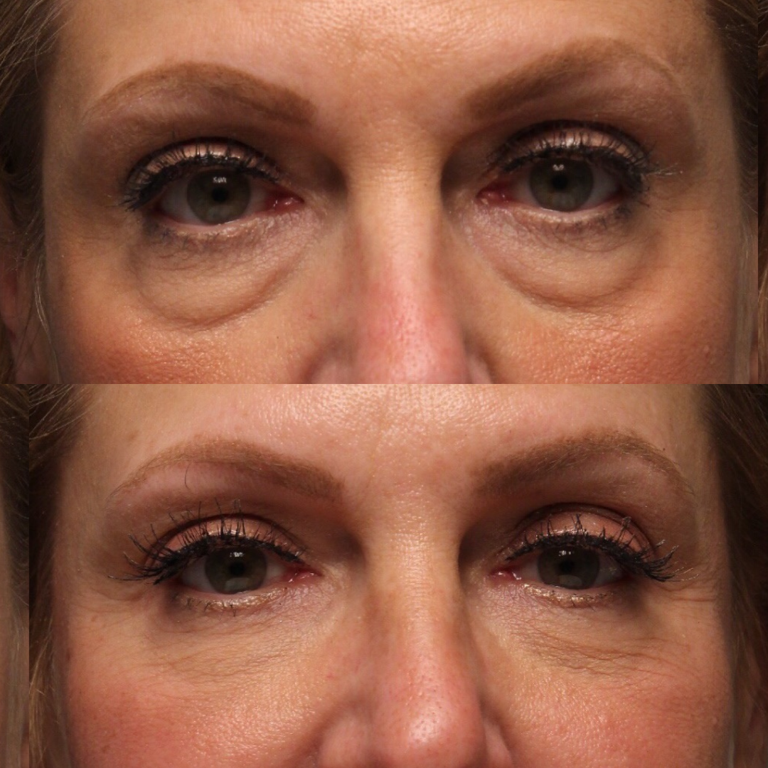 Natural Trough™ Technique (NTT) Filler Training