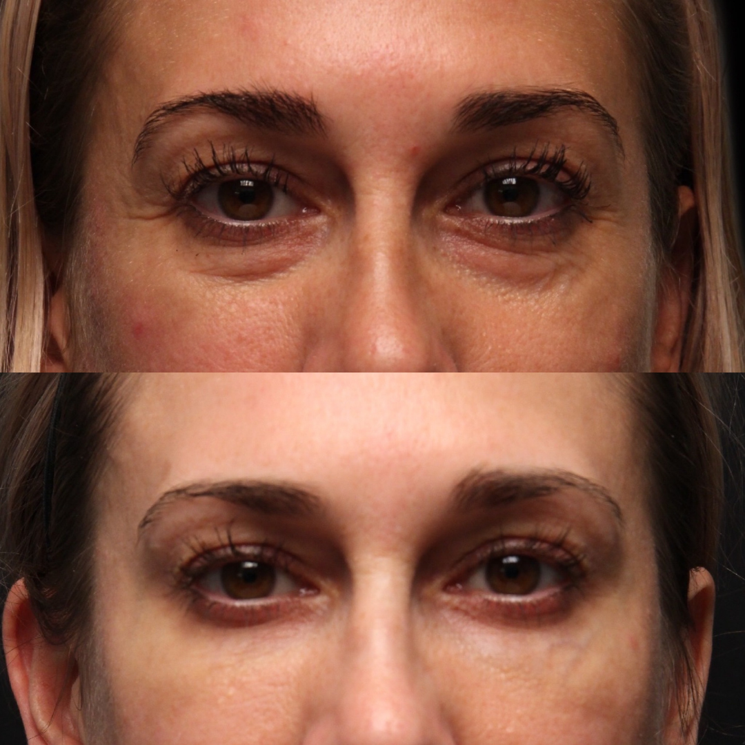 Natural Trough™ Technique (NTT) Filler Training