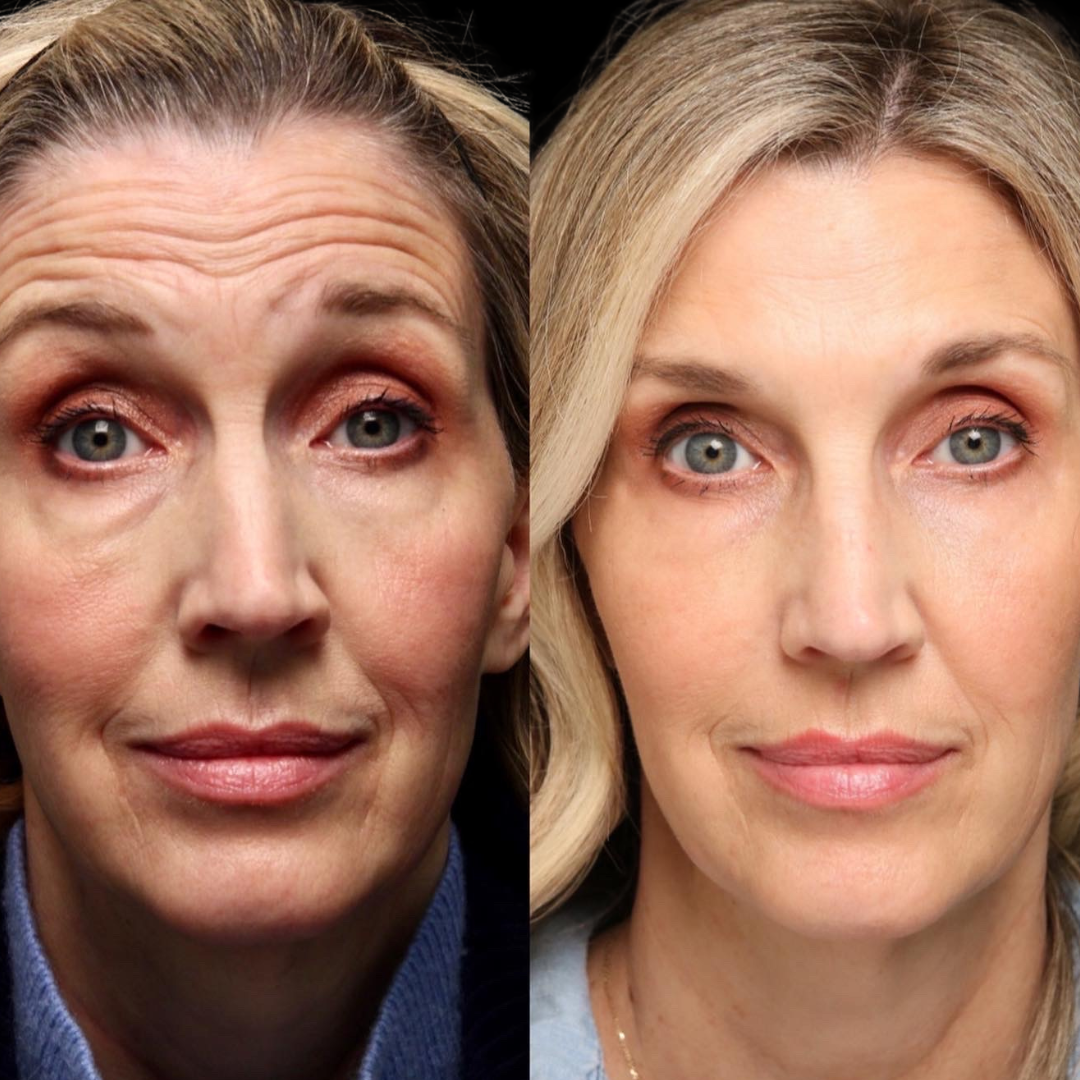 Illusion Mapping™ Filler Training