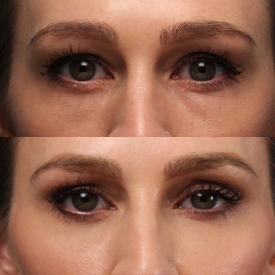 Natural Trough™ Technique (NTT) Filler Training