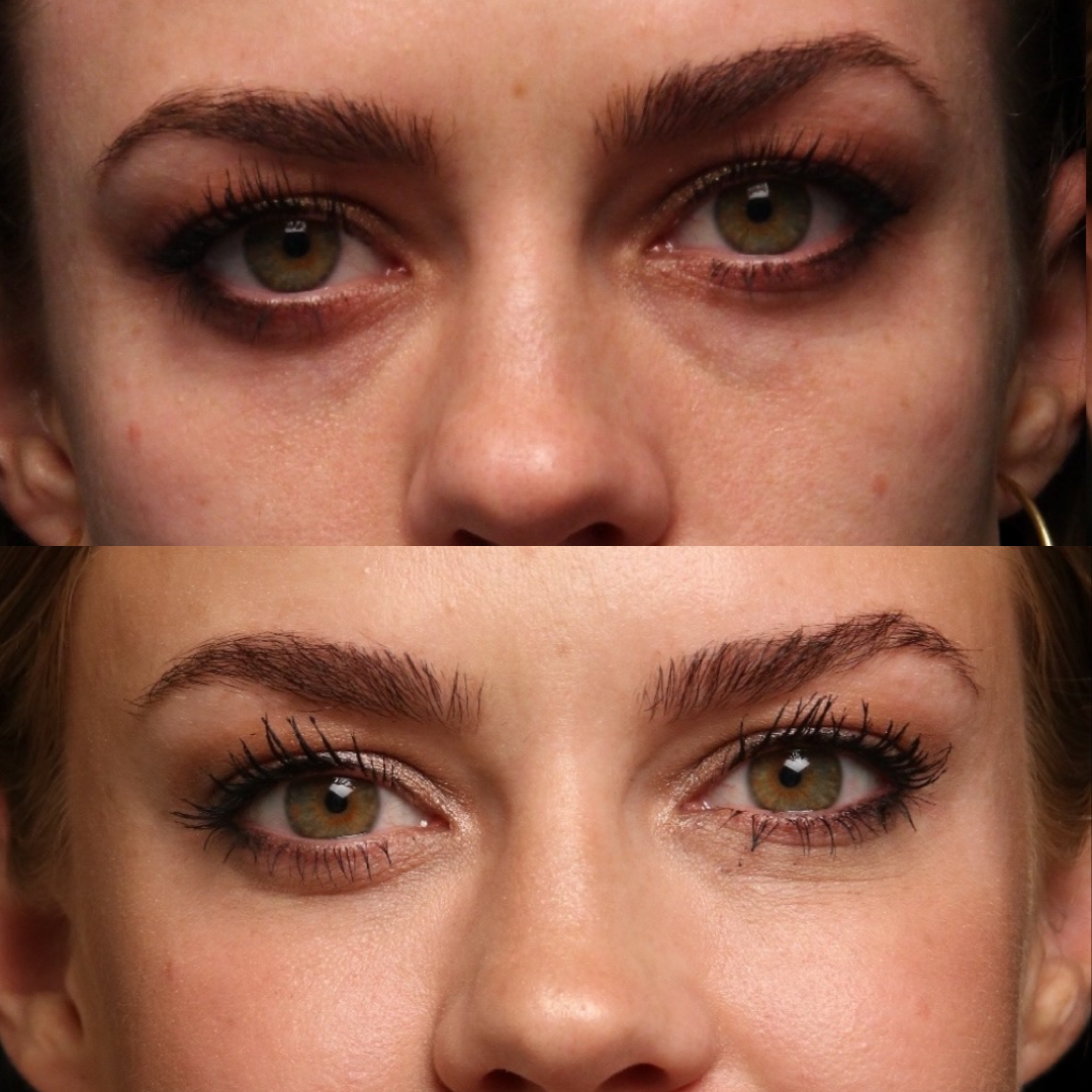 Natural Trough™ Technique (NTT) Filler Training