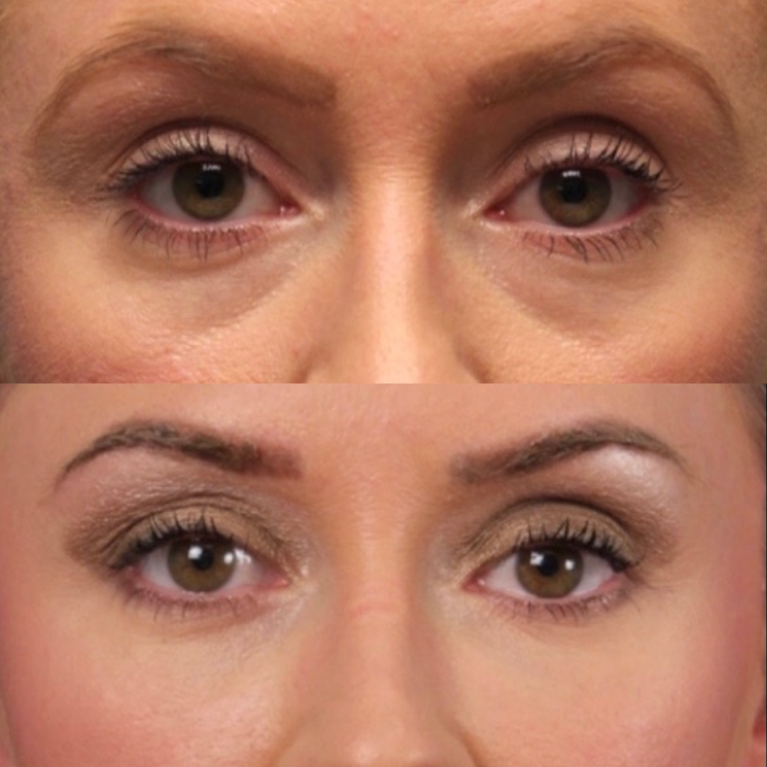 Natural Trough™ Technique (NTT) Filler Training