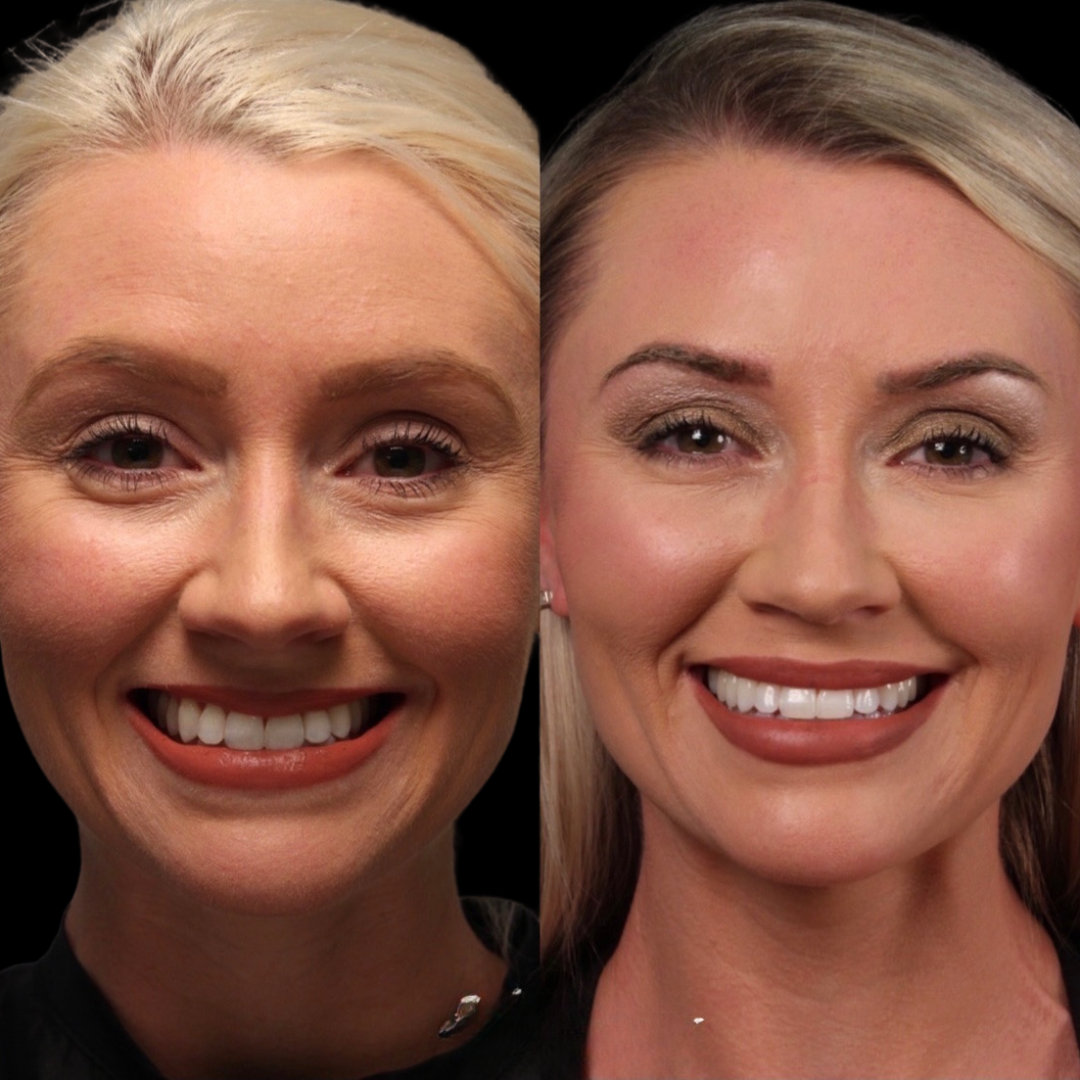 Illusion Mapping™ Filler Training