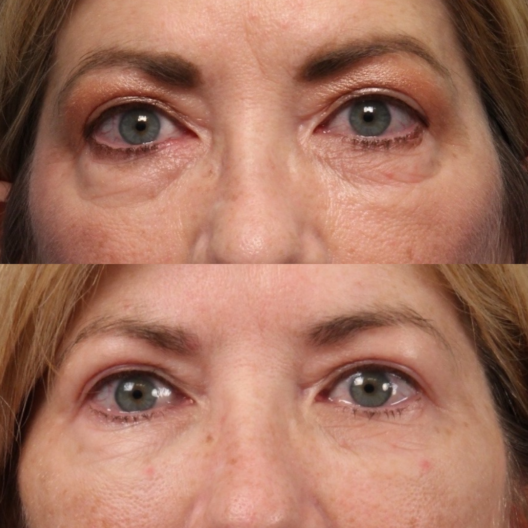 Natural Trough™ Technique (NTT) Filler Training