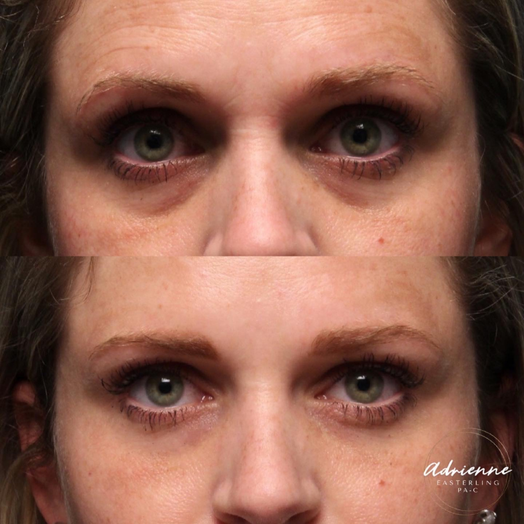 Natural Trough™ Technique (NTT) Filler Training