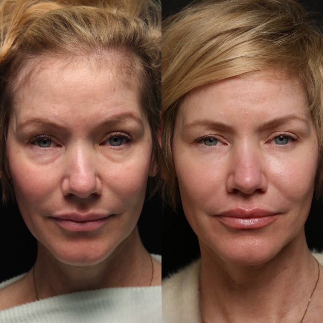 Illusion Mapping™ Filler Training