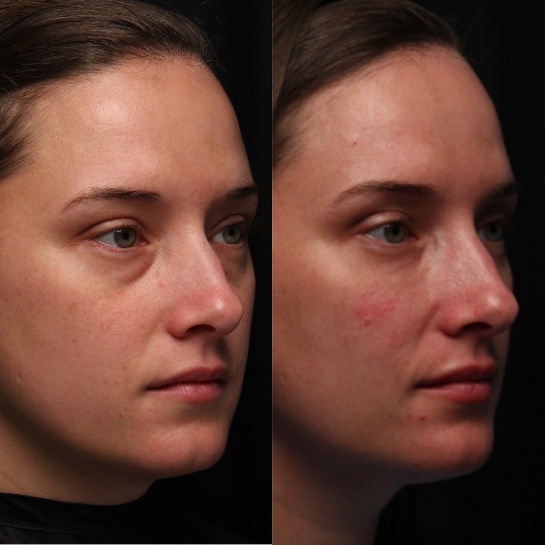 Illusion Mapping™ Filler Training