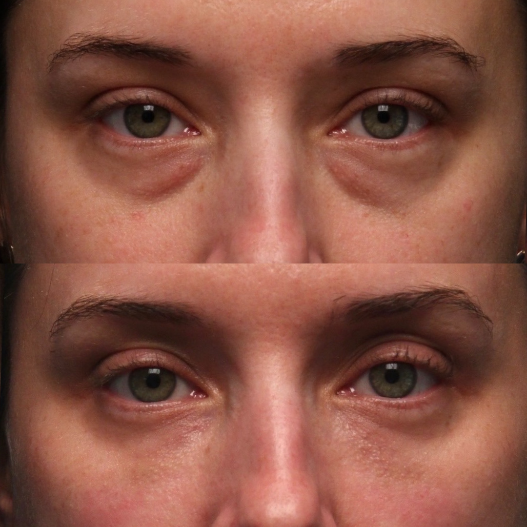 Natural Trough™ Technique (NTT) Filler Training