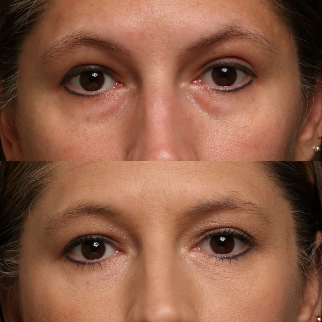 Natural Trough™ Technique (NTT) Filler Training
