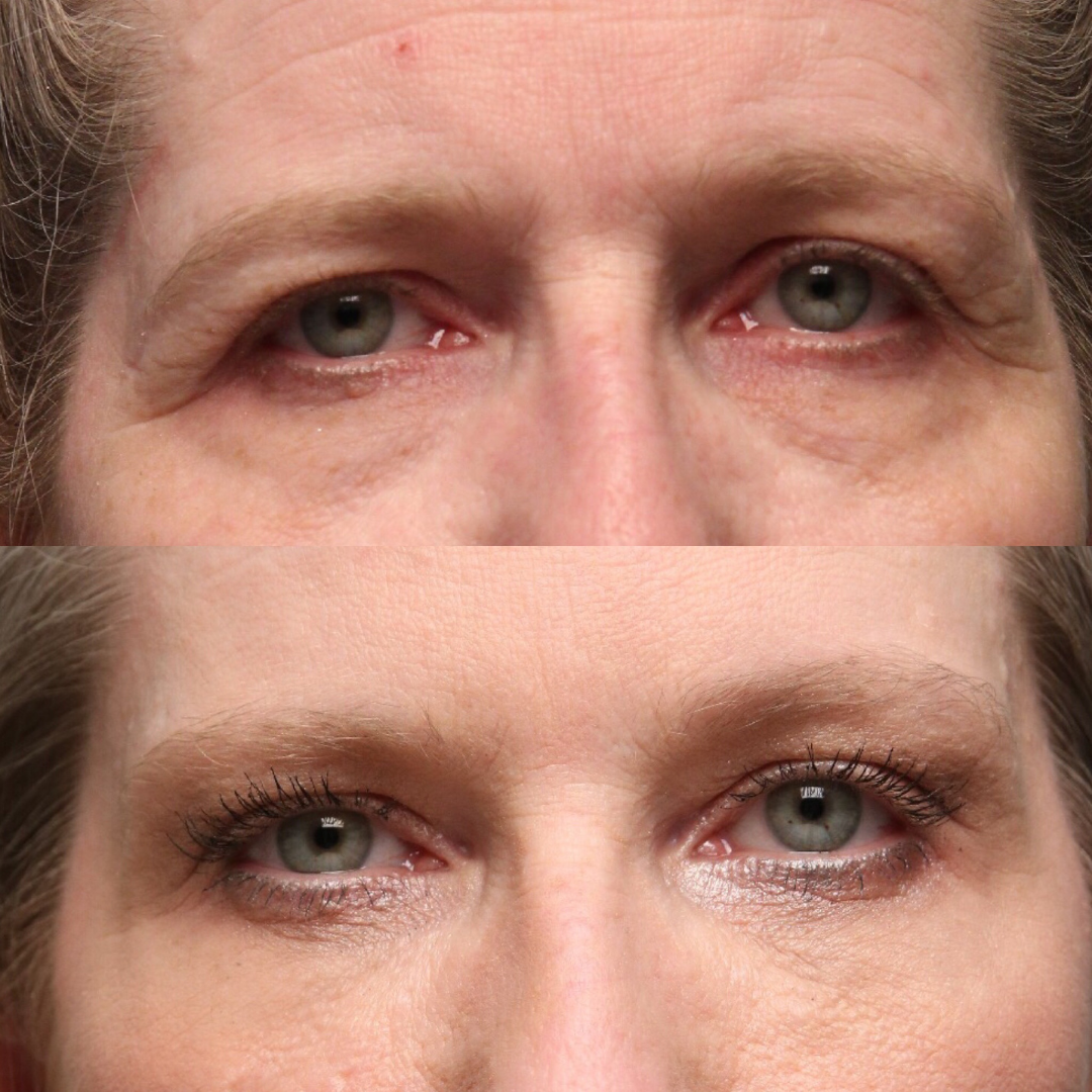 Natural Trough™ Technique (NTT) Filler Training