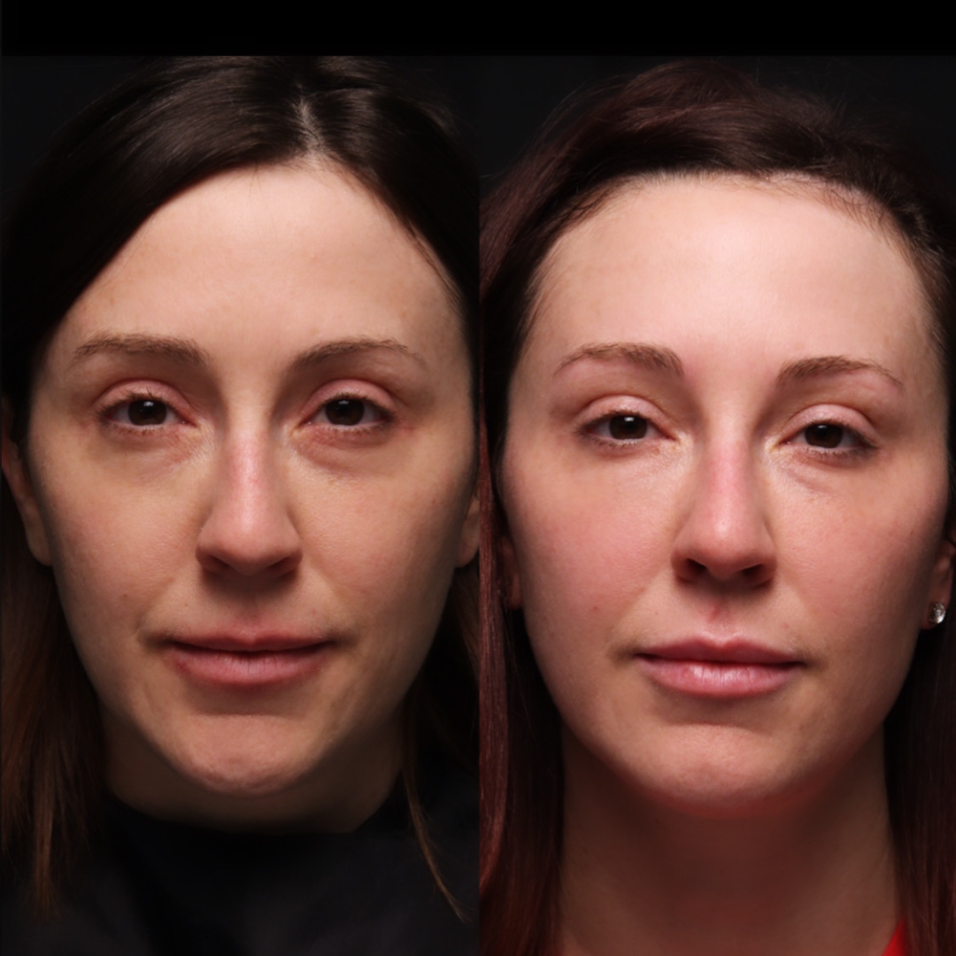 Illusion Mapping™ Filler Training