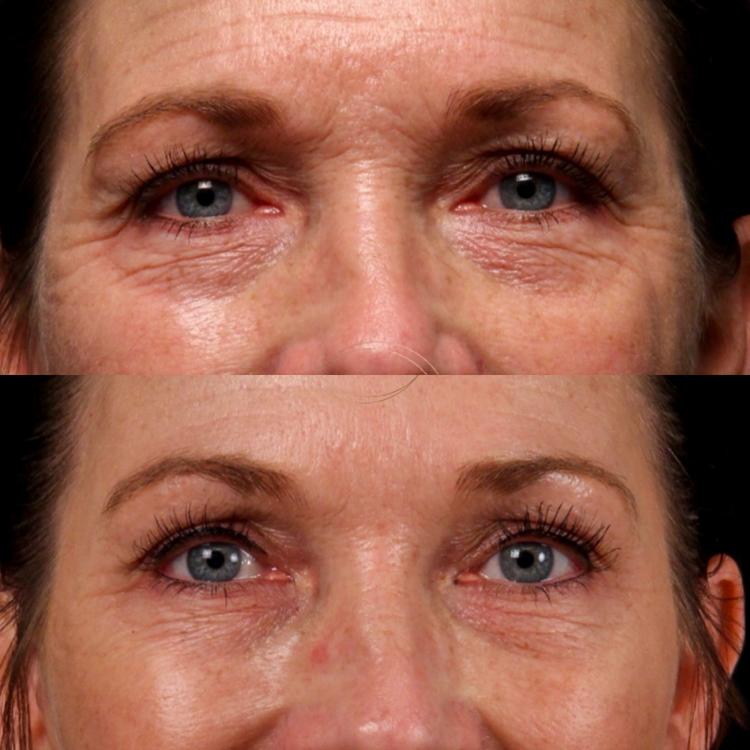 Natural Trough™ Technique (NTT) Filler Training